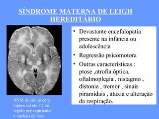 SÍNDROME MATERNA DE LEIGH HEREDITÁRIO Devastante encefalopatia presente na infância ou adolescência  Regressão psicomotora  Outras características : ptose ,atrofia óptica, oftalmoplegia , nistagmo , distonia , tremor , sinais piramidais , ataxia e alteração da respiração. RNM de crânio com  hipersinal em T2 na região periventricular e núcleos da base. 