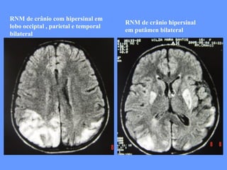 RNM de crânio com hipersinal em lobo occiptal , parietal e temporal bilateral RNM de crânio hipersinal em putâmen bilateral  