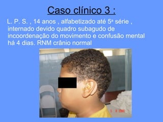 Caso clínico 3 : L. P. S. , 14 anos , alfabetizado até 5 a  série , internado devido quadro subagudo de incoordenação do movimento e confusão mental há 4 dias. RNM crânio normal 