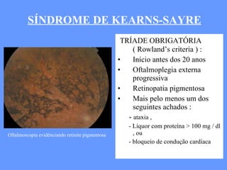 TRÍADE OBRIGATÓRIA  ( Rowland’s criteria ) : Início antes dos 20 anos  Oftalmoplegia externa progressiva  Retinopatia pigmentosa  Mais pelo menos um dos seguintes achados : -  ataxia , - Líquor com proteína > 100 mg / dl , ou - bloqueio de condução cardíaca  SÍNDROME DE KEARNS-SAYRE Oftalmoscopia evidênciando retinite pigmentosa 