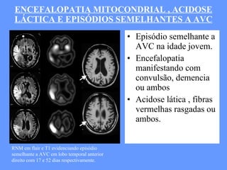 ENCEFALOPATIA MITOCONDRIAL , ACIDOSE LÁCTICA E EPISÓDIOS SEMELHANTES A AVC Episódio semelhante a AVC na idade jovem. Encefalopatia manifestando com convulsão, demencia ou ambos Acidose lática , fibras vermelhas rasgadas ou ambos. RNM em flair e T1 evidenciando episódio semelhante a AVC em lobo temporal anterior direito com 17 e 52 dias respectivamente. 