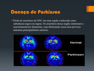 Doença de Parkinson
 Perda de neurônios do SNC em uma região conhecida como
substância negra (ou nigra). Os neurônios dessa região sintetizam o
neurotransmissor dopamina, cuja diminuição nessa área provoca
sintomas principalmente motores.
 