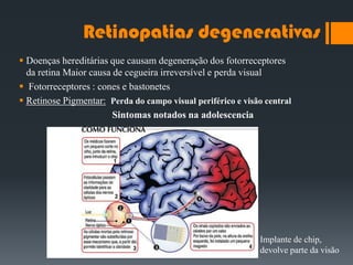 Retinopatias degenerativas
 Doenças hereditárias que causam degeneração dos fotorreceptores
da retina Maior causa de cegueira irreversível e perda visual
 Fotorreceptores : cones e bastonetes
 Retinose Pigmentar: Perda do campo visual periférico e visão central
Sintomas notados na adolescencia
Implante de chip,
devolve parte da visão
 