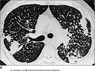 MANIFESTAÇÕES CLÍNICAS
1. Crônica:
 mais comum e ocorre após longo tempo do início da exposição de 10
a 20 anos (ex. trabalhadores de cerâmicas);
 com a progressão da doença há a coalescência dos nódulos,
podendo evoluir para grandes conglomerados;
 assintomáticos ou apresentar sintomas que em geral, são
precedidos das alterações radiológicas.
 