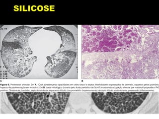 MANIFESTAÇÕES CLÍNICAS
3. Aguda:
 Forma rara da doença, associada a exposições maciças à
sílica livre, por períodos que variam de poucos meses até 4
a 5 anos (jateamento de areia, moagem de pedra);
 o padrão radiológico é caracterizado por infiltrações
alveolares difusas, progressivas, às vezes com nodulações
mal definidas;
 a dispnéia é incapacitante e pode evoluir para morte por
insuficiênciarespiratória.
 