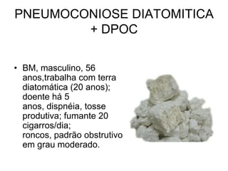 PNEUMOCONIOSE DIATOMITICA
+ DPOC
• BM, masculino, 56
anos,trabalha com terra
diatomática (20 anos);
doente há 5
anos, dispnéia, tosse
produtiva; fumante 20
cigarros/dia;
roncos, padrão obstrutivo
em grau moderado.
 