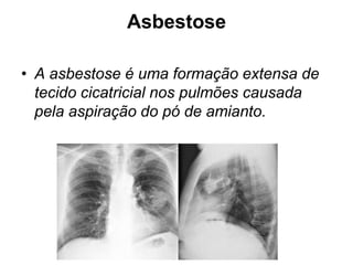 Asbestose
• A asbestose é uma formação extensa de
tecido cicatricial nos pulmões causada
pela aspiração do pó de amianto.
 