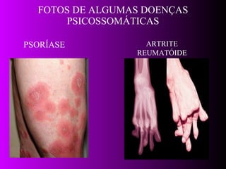 FOTOS DE ALGUMAS DOENÇAS PSICOSSOMÁTICAS PSORÍASE ARTRITE REUMATÓIDE 