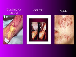 ÚLCERA NA PERNA COLITE ACNE 
