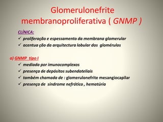 Glomerulonefrite
membranoproliferativa ( GNMP )
CLÍNICA:
 proliferação e espessamento da membrana glomerular
 acentua ção da arquitectura lobular dos glomérulos
a) GNMP tipo I
 mediada por imunocomplexos
 presença de depósitos subendoteliais
 também chamada de : glomerulonefrite mesangiocapilar
 presença de síndrome nefrótico , hematúria
 