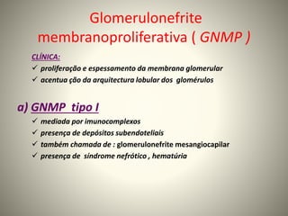 Glomerulonefrite
membranoproliferativa ( GNMP )
CLÍNICA:
 proliferação e espessamento da membrana glomerular
 acentua ção da arquitectura lobular dos glomérulos
a) GNMP tipo I
 mediada por imunocomplexos
 presença de depósitos subendoteliais
 também chamada de : glomerulonefrite mesangiocapilar
 presença de síndrome nefrótico , hematúria
 