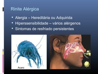 Rinite Alérgica
 Alergia – Hereditária ou Adquirida
 Hiperssensibilidade – vários alérgenos
 Sintomas de resfriado persistentes

Acaro

 