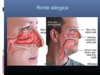 Rinite alérgica

 