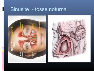 Sinusite - tosse noturna

 