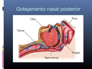 Gotejamento nasal posterior

 