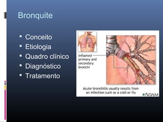 Bronquite
 Conceito
 Etiologia
 Quadro clínico
 Diagnóstico
 Tratamento

 
