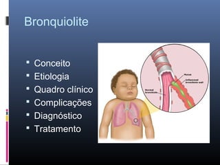 Bronquiolite
 Conceito
 Etiologia
 Quadro clínico
 Complicações
 Diagnóstico
 Tratamento

 