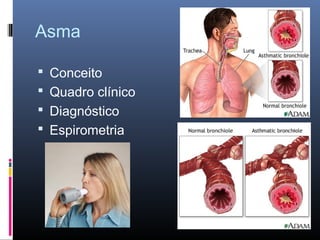 Asma
 Conceito
 Quadro clínico
 Diagnóstico
 Espirometria

 