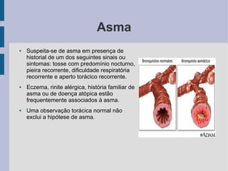Asma
●   Suspeita-se de asma em presença de
    historial de um dos seguintes sinais ou
    sintomas: tosse com predomínio nocturno,
    pieira recorrente, dificuldade respiratória
    recorrente e aperto torácico recorrente.
●   Eczema, rinite alérgica, história familiar de
    asma ou de doença atópica estão
    frequentemente associados à asma.
●   Uma observação torácica normal não
    exclui a hipótese de asma.
 