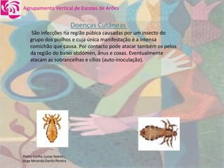 DoençAs Sexualmente..