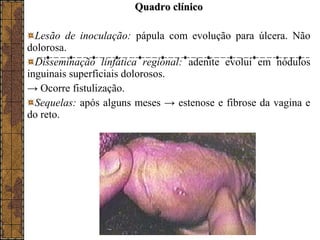 QQuuaaddrroo ccllíínniiccoo 
Lesão de inoculação: pápula com evolução para úlcera. Não 
dolorosa. 
Disseminação linfática regional: adenite evolui em nódulos 
inguinais superficiais dolorosos. 
→ Ocorre fistulização. 
Sequelas: após alguns meses → estenose e fibrose da vagina e 
do reto. 
 