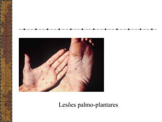 Lesões palmo-plantares 
 