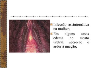 Infecção assintomática 
na mulher; 
Em alguns casos 
edema no meato 
uretral, secreção e 
ardor à micção; 
 