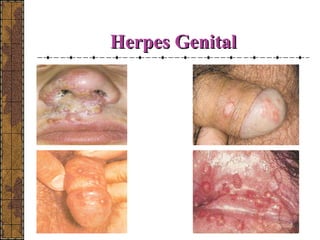 HHeerrppeess GGeenniittaall 
 