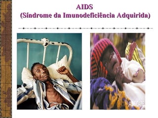 AAIIDDSS 
((SSíínnddrroommee ddaa IImmuunnooddeeffiicciiêênncciiaa AAddqquuiirriiddaa)) 
 