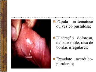 Pápula eritematoso 
ou vesico pustulosa; 
Ulceração dolorosa, 
de base mole, rasa de 
bordas irregulares; 
Exsudato necrótico-purulento; 
 