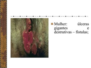 Mulher: úlceras 
gigantes e 
destrutivas – fístulas; 
 