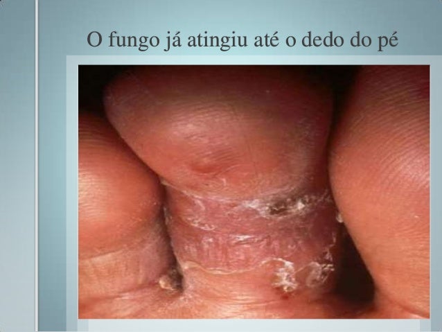 Como é correto para processar pregos que estão em um fungo