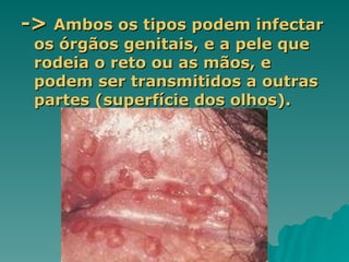 ->
-> Ambos os tipos podem infectar
Ambos os tipos podem infectar
os órgãos genitais, e a pele que
os órgãos genitais, e a pele que
rodeia o reto ou as mãos, e
rodeia o reto ou as mãos, e
podem ser transmitidos a outras
podem ser transmitidos a outras
partes (superfície dos olhos).
partes (superfície dos olhos).
 