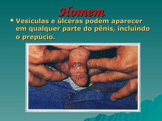 Homem
Homem
 Vesículas e úlceras podem aparecer
Vesículas e úlceras podem aparecer
em qualquer parte do pênis, incluindo
em qualquer parte do pênis, incluindo
o prepúcio.
o prepúcio.
 