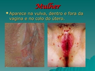 Mulher
Mulher
 Aparece na vulva, dentro e fora da
Aparece na vulva, dentro e fora da
vagina e no colo do útero.
vagina e no colo do útero.
 