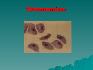 Tricomoníase
Tricomoníase
 