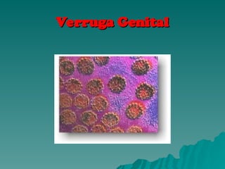Verruga Genital
Verruga Genital
 