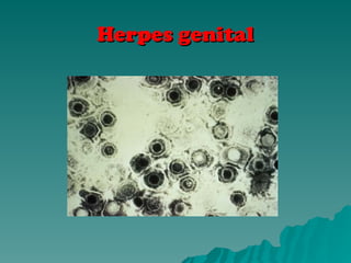 Herpes genital
Herpes genital
 