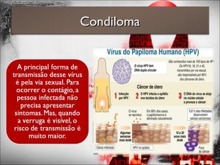 CondilomaCondiloma
 