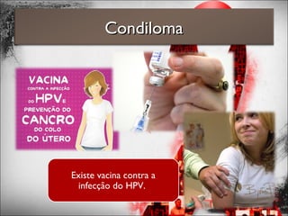CondilomaCondiloma
Existe vacina contra a
infecção do HPV.
 