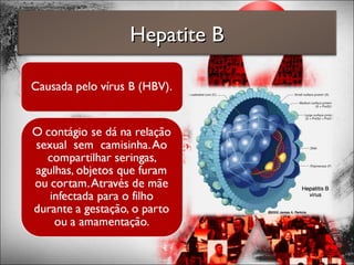 Hepatite BHepatite B
 
