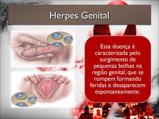 Herpes GenitalHerpes Genital
 