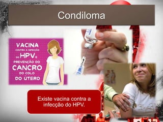 Condiloma




Existe vacina contra a
  infecção do HPV.
 