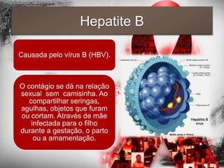 Hepatite B

Causada pelo vírus B (HBV).



O contágio se dá na relação
sexual sem camisinha. Ao
   compartilhar seringas,
agulhas, objetos que furam
ou cortam. Através de mãe
    infectada para o filho
durante a gestação, o parto
     ou a amamentação.
 