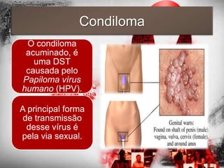 Condiloma
 O condiloma
 acuminado, é
   uma DST
 causada pelo
Papiloma vírus
humano (HPV).

A principal forma
de transmissão
 desse vírus é
pela via sexual.
 