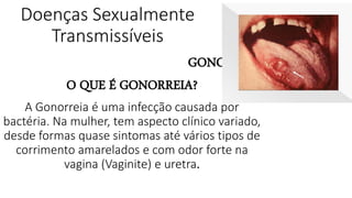 Doenças Sexualmente
Transmissíveis
GONORREIA
O QUE É GONORREIA?
A Gonorreia é uma infecção causada por
bactéria. Na mulher, tem aspecto clínico variado,
desde formas quase sintomas até vários tipos de
corrimento amarelados e com odor forte na
vagina (Vaginite) e uretra.
 
