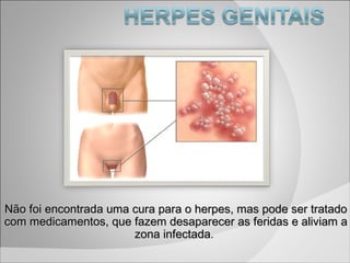 Não foi encontrada uma cura para o herpes, mas pode ser tratado com medicamentos, que fazem desaparecer as feridas e alivi...