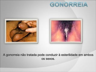 A gonorreia não tratada pode conduzir à esterilidade em ambos os sexos. 