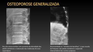 Rx p da coluna lombar com aumento da densidade dos
platôs vertebrais e reabsorção das trabéculas do osso
espondjoso
Biconcavidade ou “vértebra de bacalhau”, o que resulta
da fraqueza dos platôs vertebrais e expansão
intervertebral dos núcleos pulposos
 