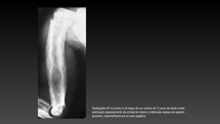 Radiografia AP do ombro e do braço de um menino de 12 anos de idade revela
acentuado espessamento da cortical do úmero e trabéculas ósseas de aspecto
grosseiro, assemelhando-se ao osso pagético.
 
